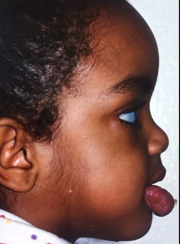 Before Image: Venous Malformation - right-side