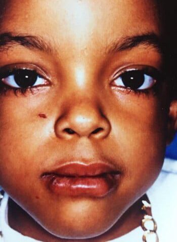 After Image: Venous Malformation - front