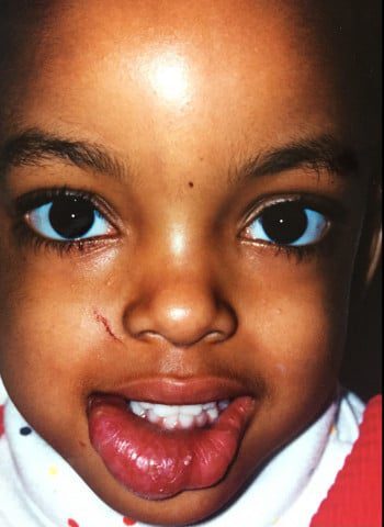 Before Image: Venous Malformation - front