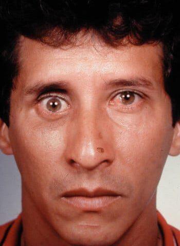 Before Image: Orbital Fracture - front