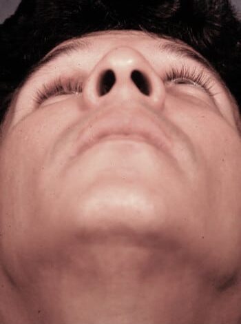 Before Image: Orbital Fracture - front