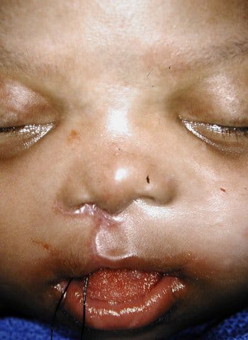 After Image: Cleft Lip - front