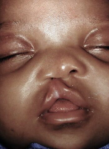 Before Image: Cleft Lip - front