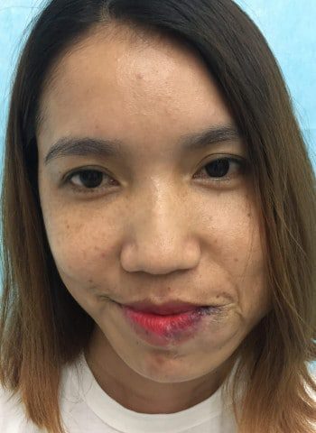 After Image: Venous Malformation - front