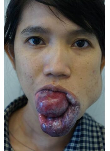 Before Image: Venous Malformation - front