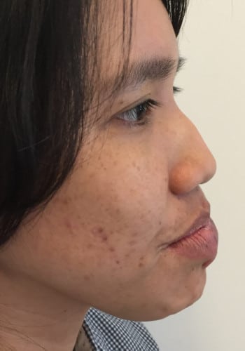 After Image: Venous Malformation - right-side