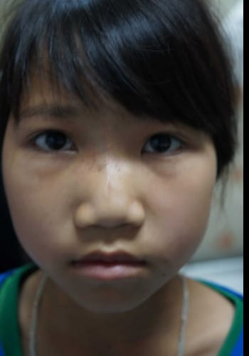 After Image: Venous Malformation - front