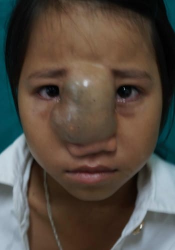 Before Image: Venous Malformation - front