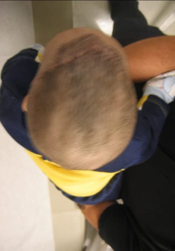After Image: Craniosynostosis - front