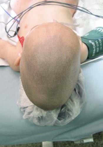 Before Image: Craniosynostosis - front