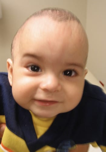 After Image: Craniosynostosis - other