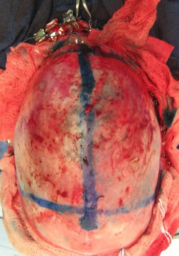 Before Image: Craniosynostosis - other