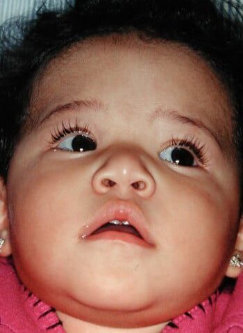 After Image: Craniosynostosis - front