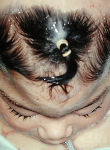Before Image: Craniosynostosis - front