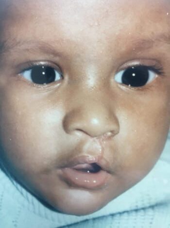 After Image: Cleft Lip - front