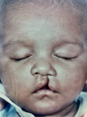 Before Image: Cleft Lip - front
