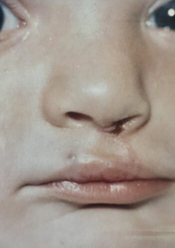 After Image: Cleft Lip - front