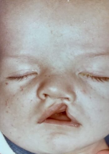 Before Image: Cleft Lip - front