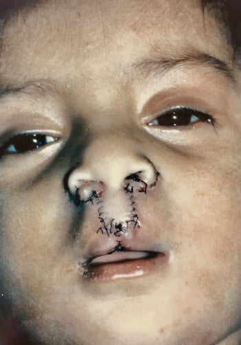After Image: Cleft Lip - front