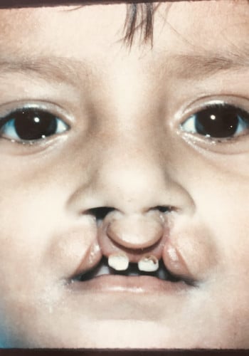 Before Image: Cleft Lip - front