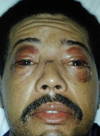 Before Image: Cranio Orbital Fracture - front