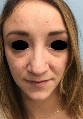 After Image: Nasal Reconstruction - front
