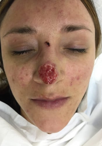 Before Image: Nasal Reconstruction - front