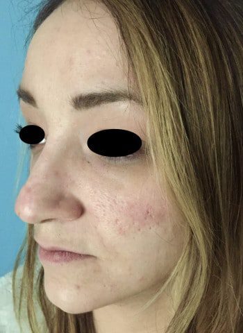 After Image: Nasal Reconstruction - left-front-oblique