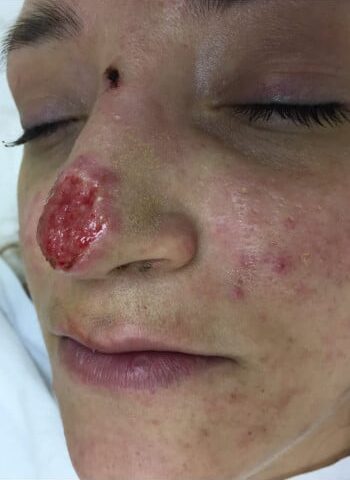 Before Image: Nasal Reconstruction - left-front-oblique