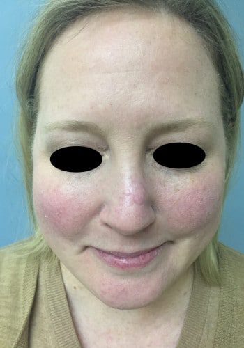 After Image: Nasal Reconstruction - front