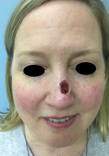 Before Image: Nasal Reconstruction - front