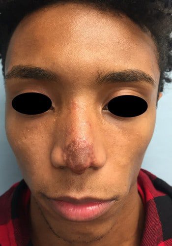 After Image: Nasal Reconstruction - front