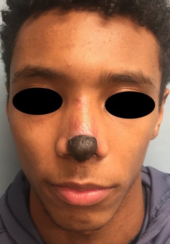 Before Image: Nasal Reconstruction - front