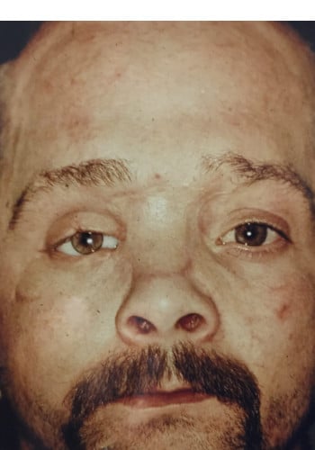 After Image: Nasal Reconstruction - front
