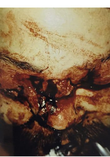 Before Image: Nasal Reconstruction - front