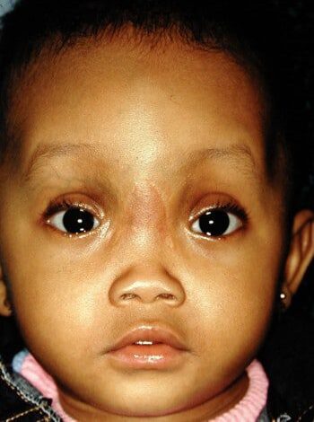 After Image: Encephalocele - front