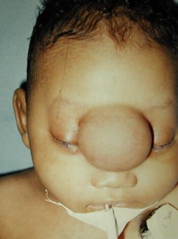 Before Image: Encephalocele - front