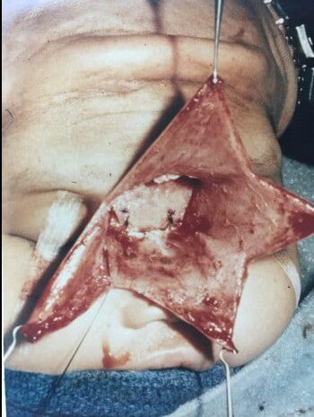 After Image: Encephalocele - left-side