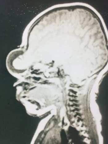 Before Image: Encephalocele - left-side