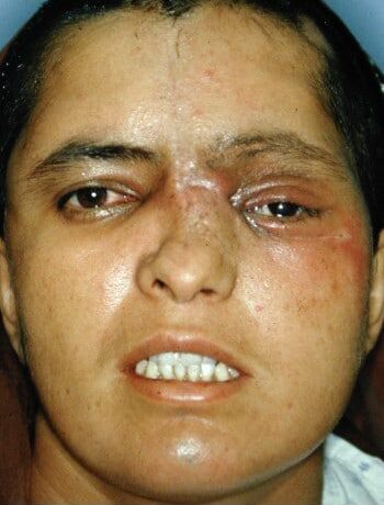 After Image: Craniofacial Tumor - front