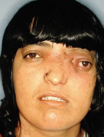 Before Image: Craniofacial Tumor - front