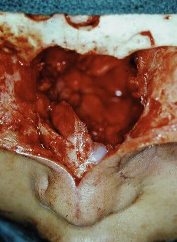 After Image: Craniofacial Tumor - front