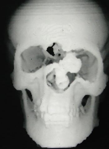 Before Image: Craniofacial Tumor - front