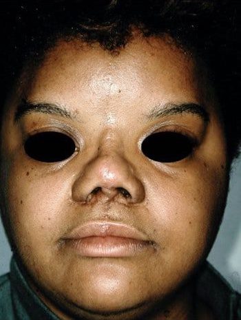 After Image: Craniofacial - front