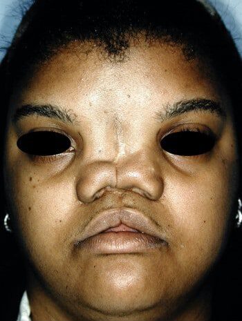 Before Image: Craniofacial - front