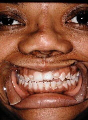After Image: Craniofacial - front