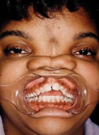 Before Image: Craniofacial - front