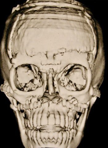 After Image: Craniofacial - front