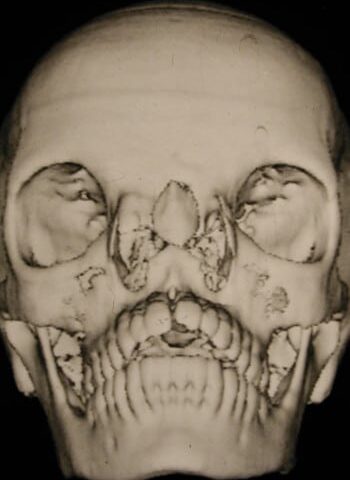 Before Image: Craniofacial - front