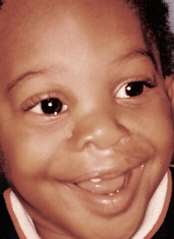 After Image: Facial Cleft - right-front-oblique